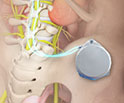 Intrathecal Morphine Pain Pump Implant