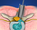 Invasive Percutaneous Spine Surgery