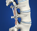 Lumbar Spinal Fusion Surgery